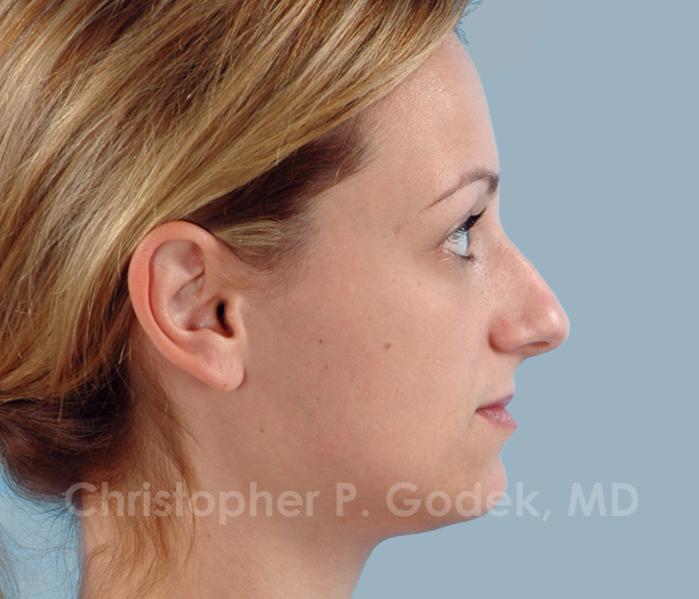 Rhinoplasty  Before & After Image