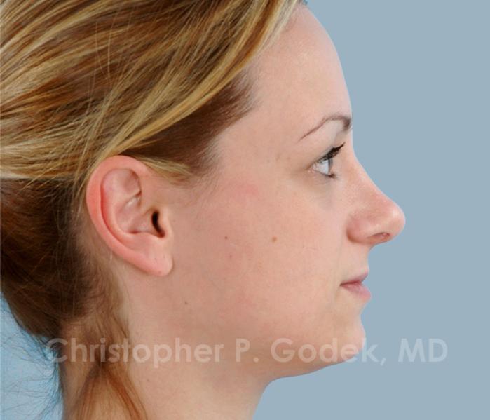 Rhinoplasty  Before & After Image