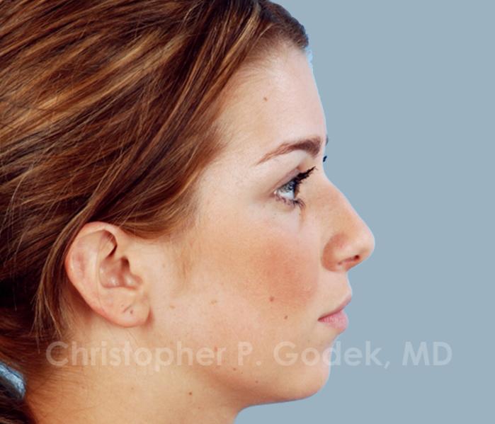 Rhinoplasty  Before & After Image