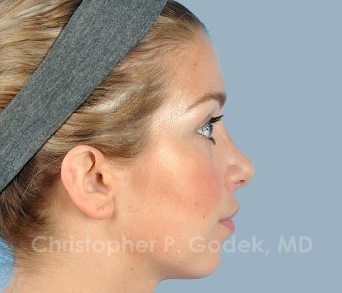 Rhinoplasty  Before & After Image