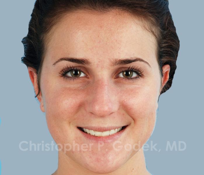 Rhinoplasty  Before & After Image