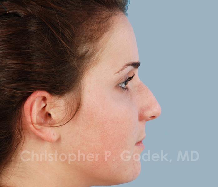 Rhinoplasty  Before & After Image