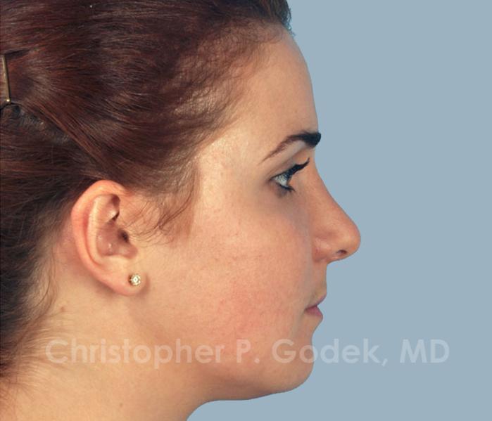 Rhinoplasty  Before & After Image