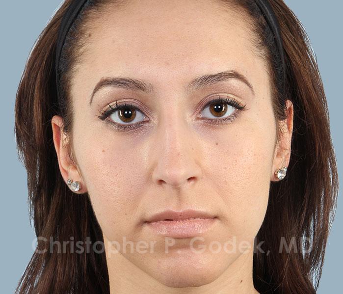Rhinoplasty  Before & After Image