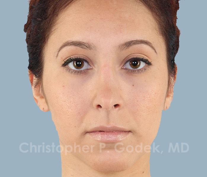 Rhinoplasty  Before & After Image