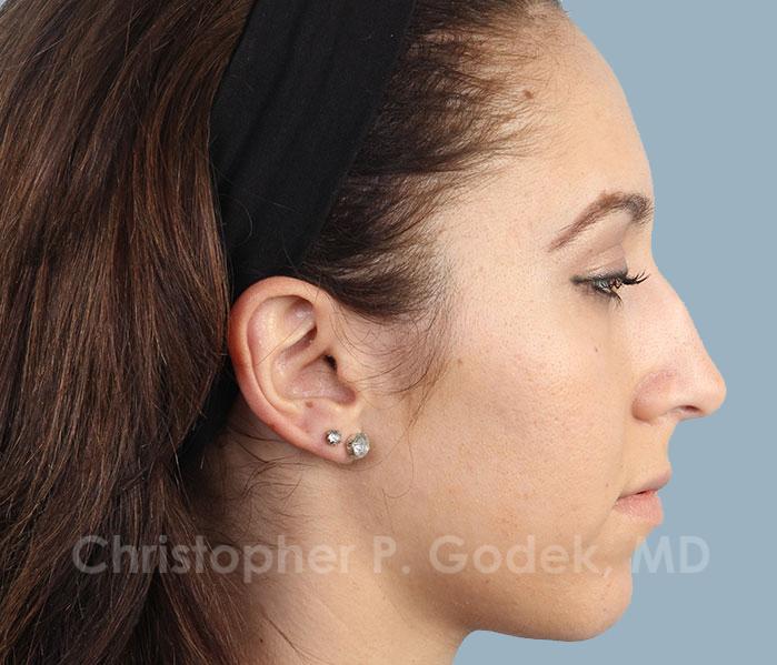 Rhinoplasty  Before & After Image