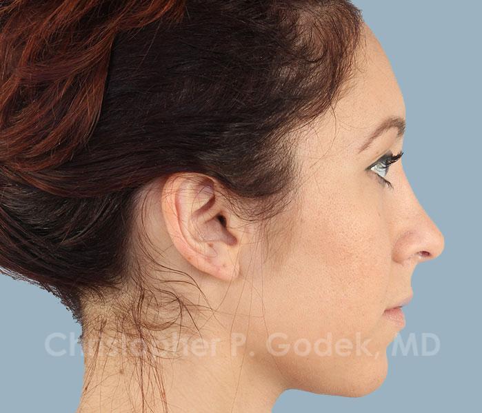 Rhinoplasty  Before & After Image