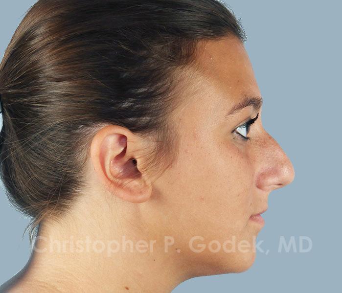 Rhinoplasty  Before & After Image