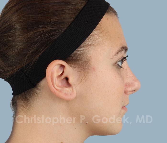 Rhinoplasty  Before & After Image