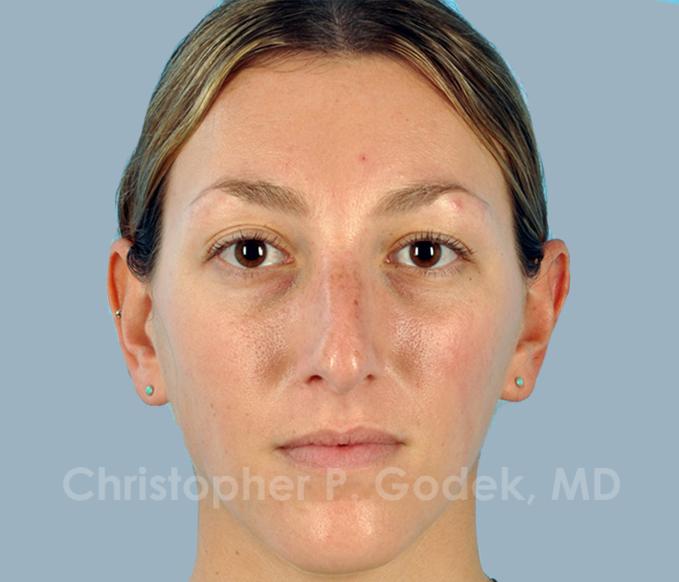 Rhinoplasty  Before & After Image