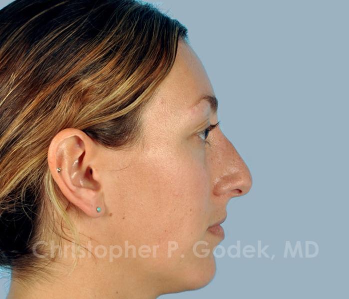 Rhinoplasty  Before & After Image