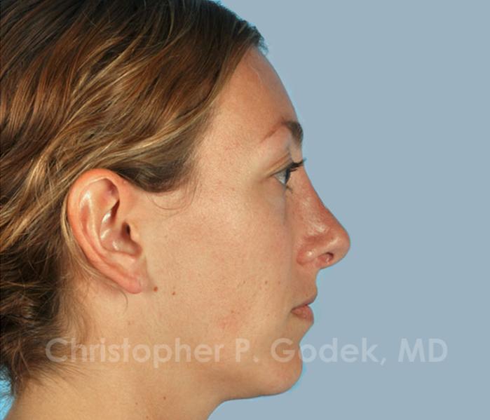 Rhinoplasty  Before & After Image