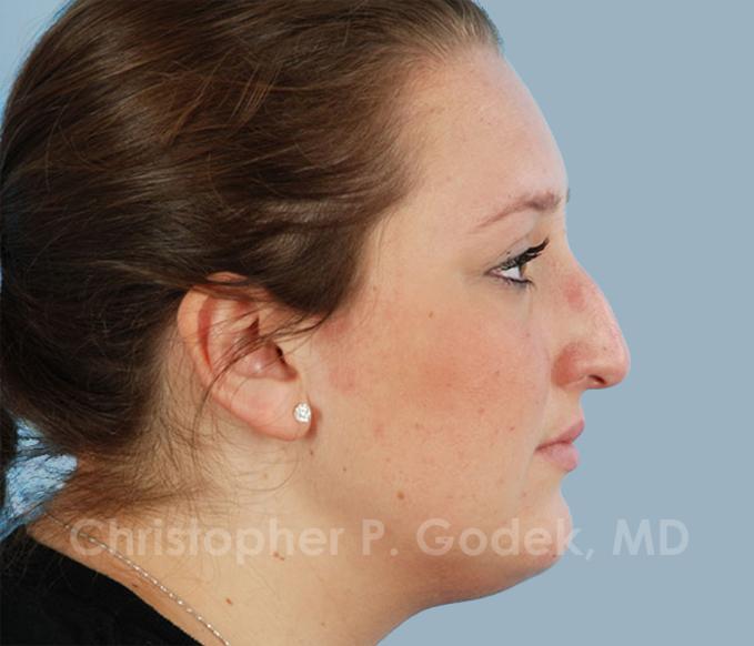 Rhinoplasty  Before & After Image