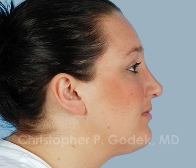 Rhinoplasty  Before & After Image