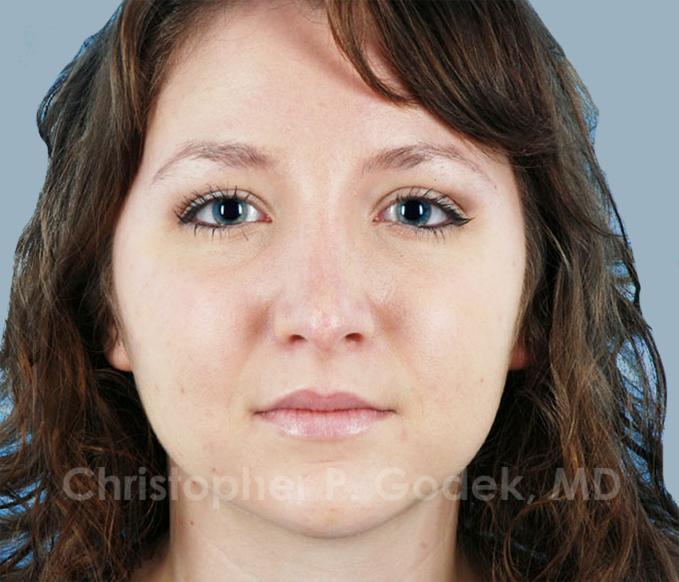 Rhinoplasty  Before & After Image