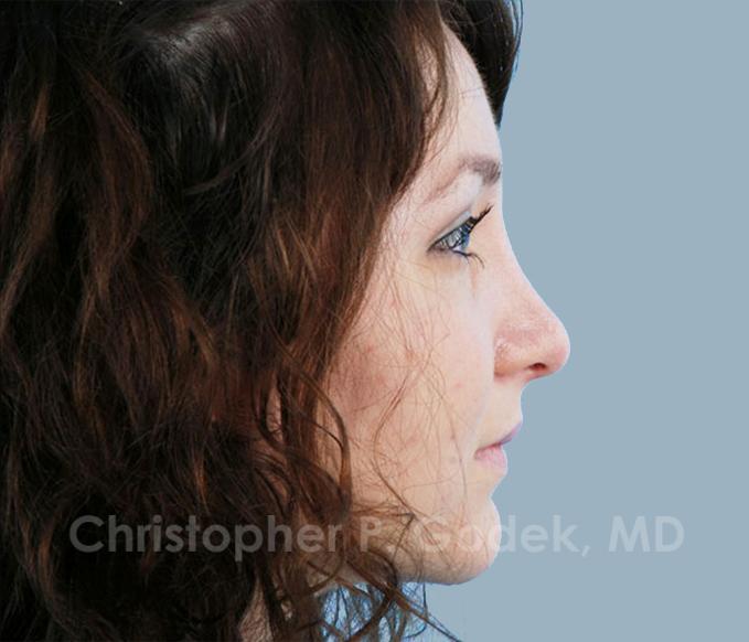 Rhinoplasty  Before & After Image