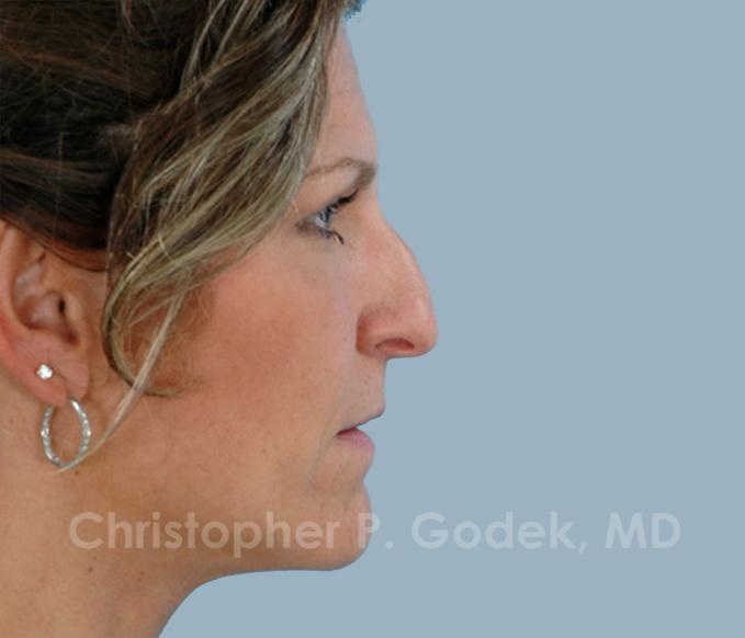 Rhinoplasty  Before & After Image