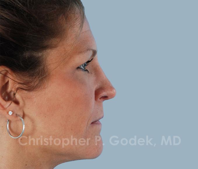 Rhinoplasty  Before & After Image