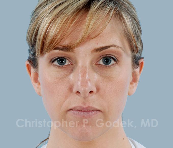 Rhinoplasty  Before & After Image