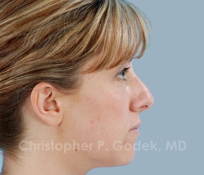 Rhinoplasty  Before & After Image