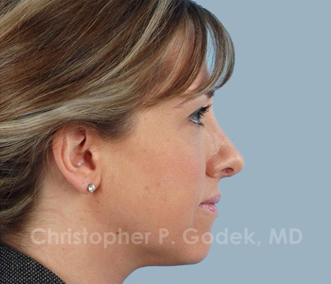 Rhinoplasty  Before & After Image