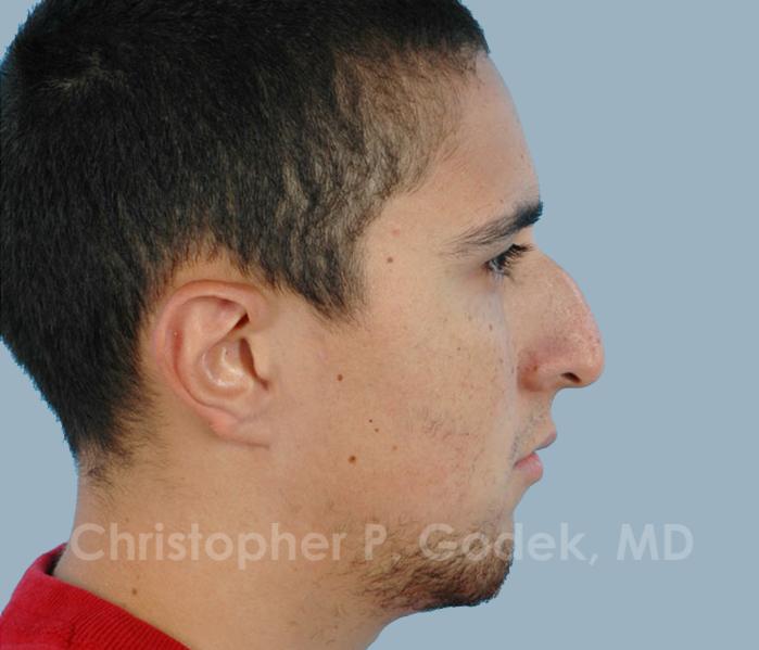 Rhinoplasty  Before & After Image