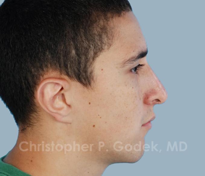 Rhinoplasty  Before & After Image