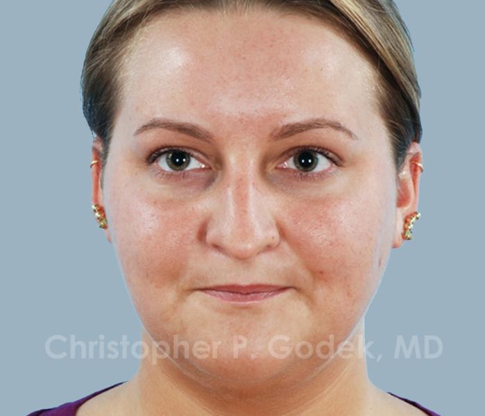 Rhinoplasty  Before & After Image