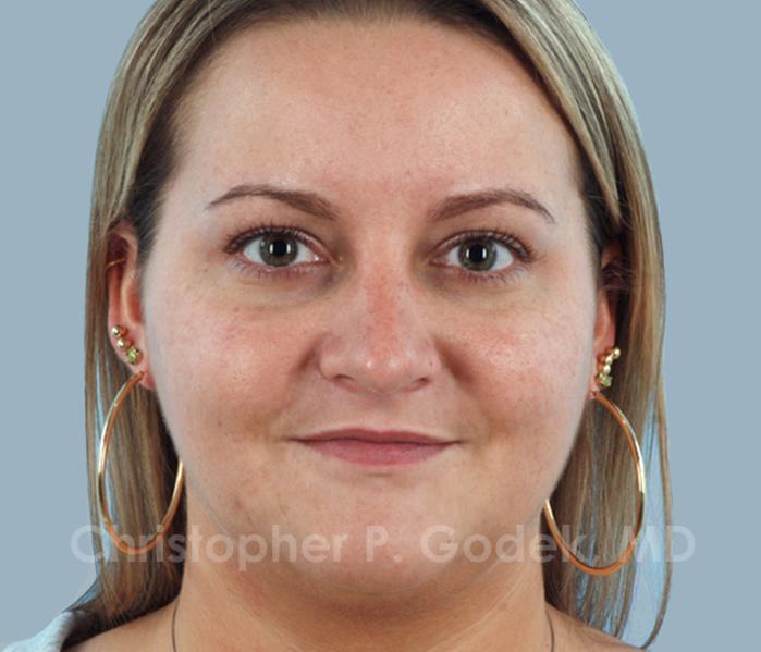 Rhinoplasty  Before & After Image