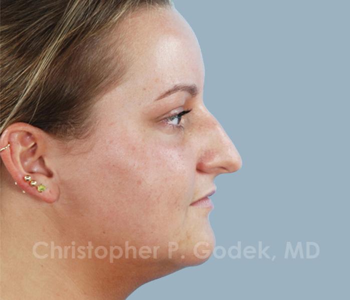 Rhinoplasty  Before & After Image