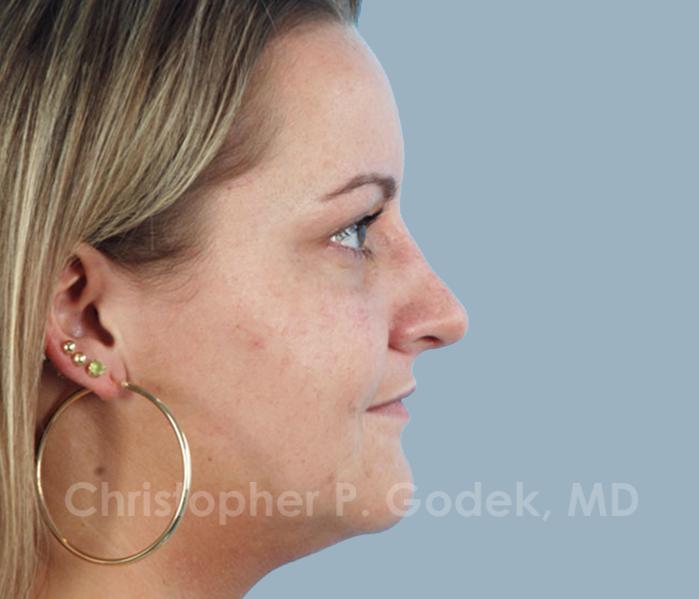 Rhinoplasty  Before & After Image