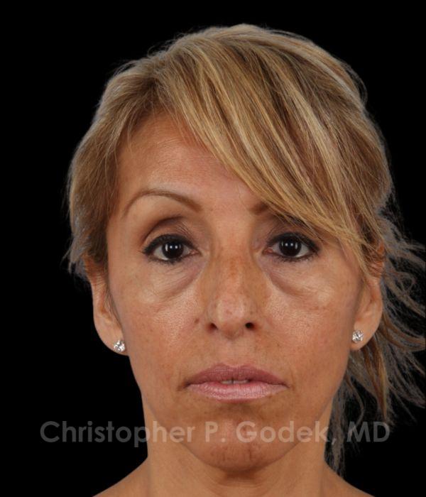 Rhinoplasty Before & After Image