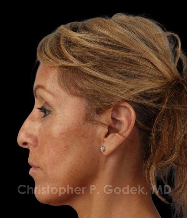 Rhinoplasty Before & After Image