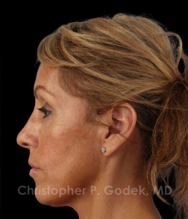 Rhinoplasty Before & After Image