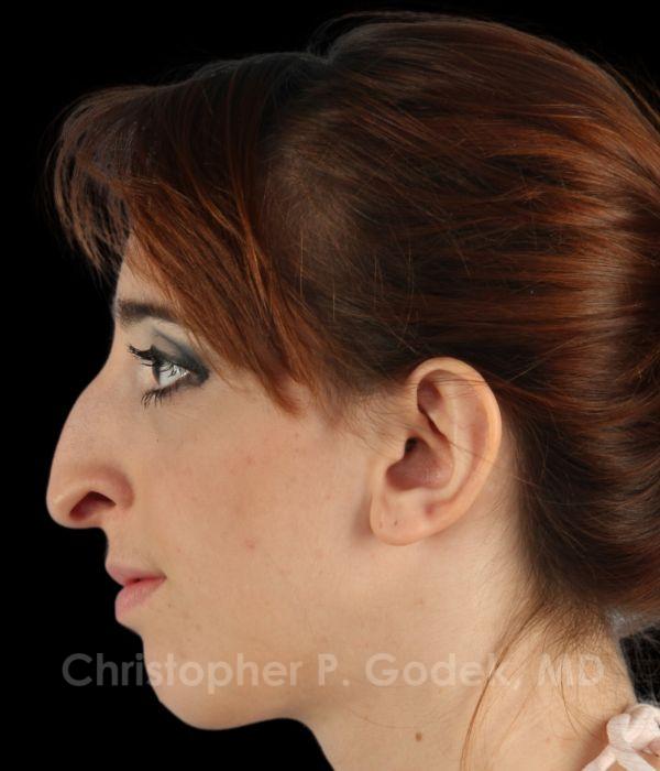 Rhinoplasty Before & After Image