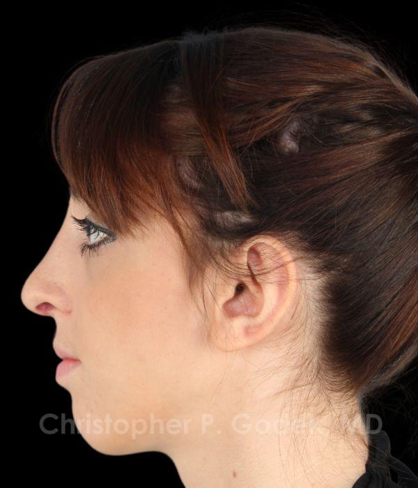 Rhinoplasty Before & After Image