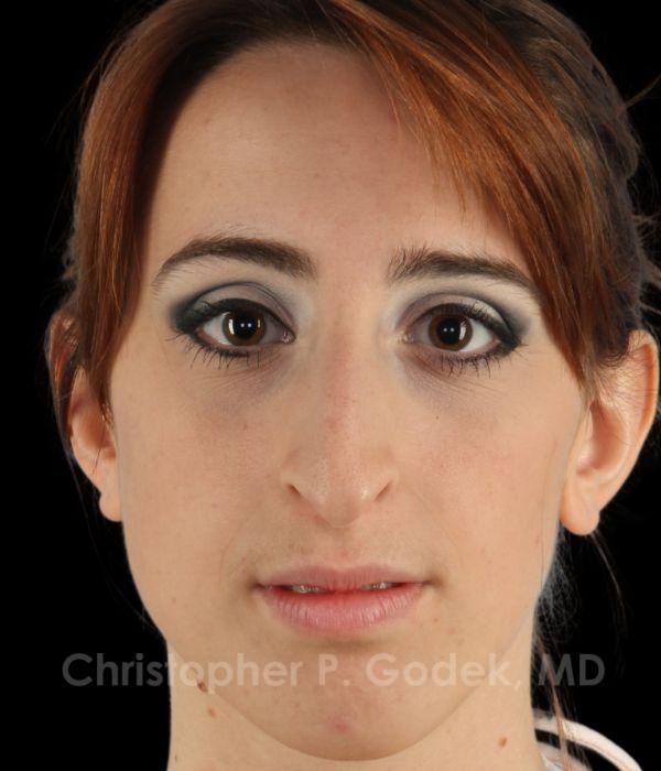 Rhinoplasty Before & After Image