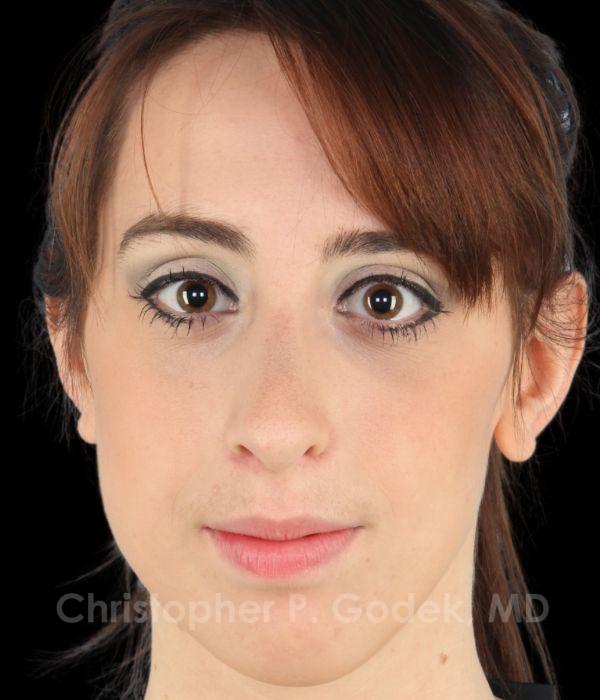 Rhinoplasty Before & After Image