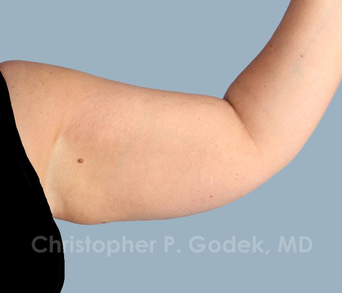 Arm Contouring Before & After Image