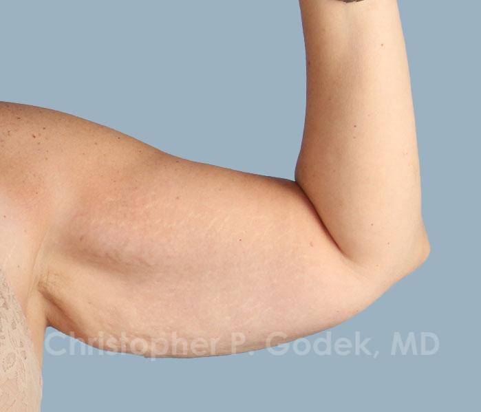 Arm Contouring Before & After Image