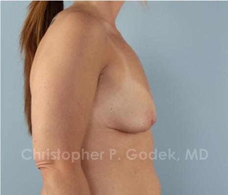 Lift with Implants Before & After Image