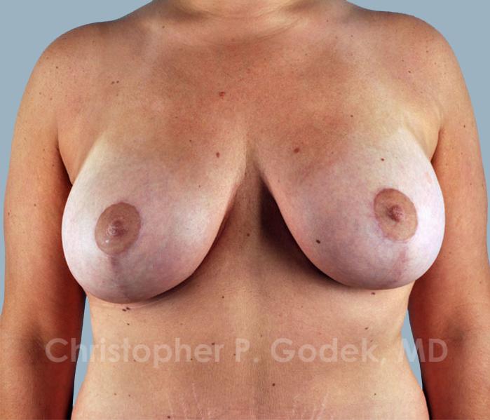 Lift with Implants Before & After Image