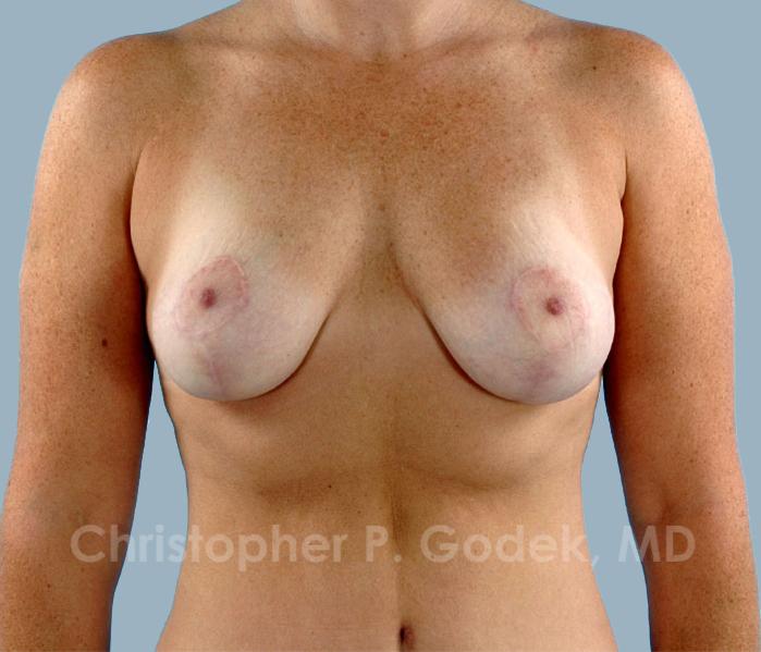 Breast Lift  Before & After Image