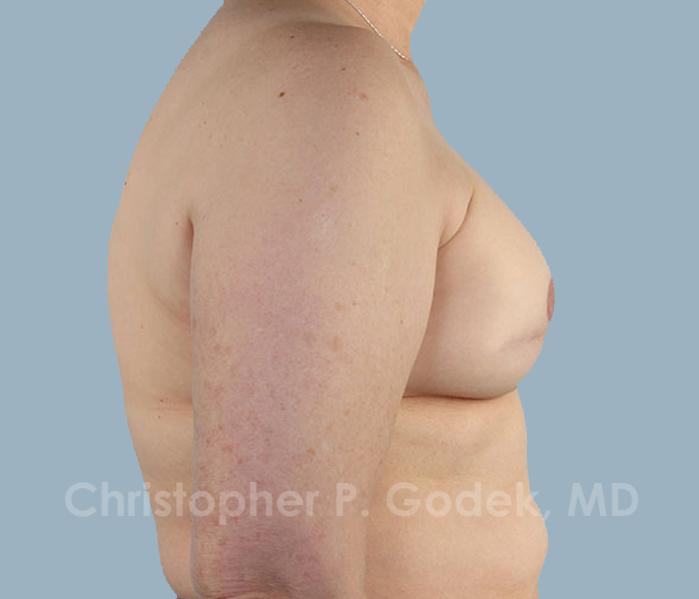 Breast Reconstruction  Before & After Image