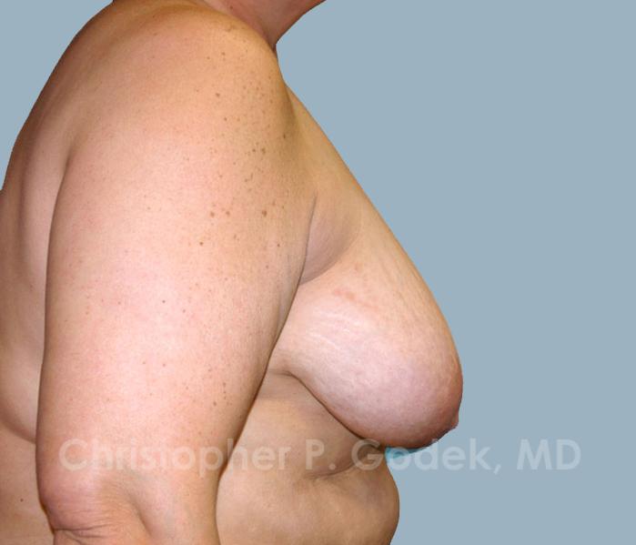 Breast Reconstruction  Before & After Image