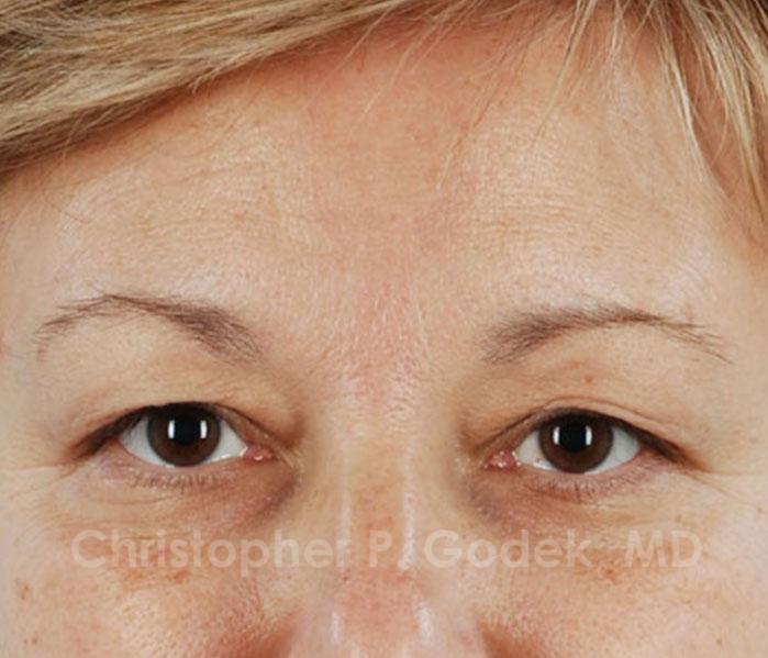 Eyelid Lift Before & After Image